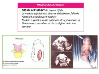 MIELOSQUISIS (hendidura)
• FORMA MAS GRAVE de espina bífida.
• La medula espinal esta abierta, debido a un fallo de
fusión en los pliegues neurales.
• Medula espinal -> masa aplanada de tejido nervioso.
• El neuroporo dorsal no se cierra al final de la 4ta
semana.
 