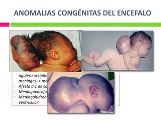 ANOMALIAS CONGÉNITAS DEL ENCEFALO
 Cierre defectuoso del neuroporo anterior durante la
4ta semana y afectan los tejidos suprayacenyes,
meninges y bóveda craneal.
CRÁNEO BÍFIDO
• Porción escamosa del hueso occipital, afectación del
agujero occipital produciendo herniación de las
meninges -> meningocele craneal.
• Afecta a 1 de cada 2000 RN
• Meningoencefalocele
• Meningohidroencefalocele -> parte del sistema
ventricular.
 