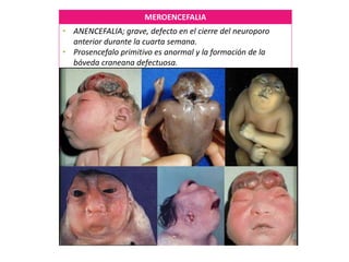 MEROENCEFALIA
• ANENCEFALIA; grave, defecto en el cierre del neuroporo
anterior durante la cuarta semana.
• Prosencefalo primitivo es anormal y la formación de la
bóveda craneana defectuosa.
• Tronco encefálico rudimentario y tejido neural funcional en
los RN vivos.
• Es mortal; se presenta en 1 de c/1000.
• Frecuente en mujeres, se asocia a acrania y raquisquisis.
• Sobrevida de un periodo corto.
• Dx. Intraparto por medio de la AFP, polihidramnios (no existe
control neurológico), ecografía y RM.
EXENCEFALIA
• ENCEFALO EXPUESTO.
• Tejido nervioso degenera.
• El resto del encéfalo es una masa esponjosa formada
en su mayoría por estructuras del romencefalo.
 