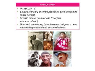 MICROCEFALIA
• INFRECUENTE.
• Bóveda craneal y encéfalo pequeños, pero tamaño de
rostro normal.
• Retraso mental pronunciado (encéfalo
subdesarrollado).
• Sinostosis prematura; bóveda craneal delgada y tiene
marcas exageradas de las circunvoluciones.
 