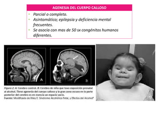 AGENESIA DEL CUERPO CALLOSO
• Parcial o completo.
• Asintomático; epilepsia y deficiencia mental
frecuentes.
• Se asocia con mas de 50 sx congénitos humanos
diferentes.
 