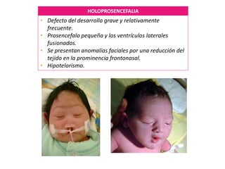 HOLOPROSENCEFALIA
• Defecto del desarrollo grave y relativamente
frecuente.
• Prosencefalo pequeño y los ventrículos laterales
fusionados.
• Se presentan anomalías faciales por una reducción del
tejido en la prominencia frontonasal.
• Hipotelorismo.
 