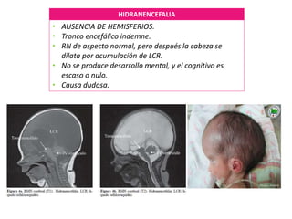 HIDRANENCEFALIA
• AUSENCIA DE HEMISFERIOS.
• Tronco encefálico indemne.
• RN de aspecto normal, pero después la cabeza se
dilata por acumulación de LCR.
• No se produce desarrollo mental, y el cognitivo es
escaso o nulo.
• Causa dudosa.
 