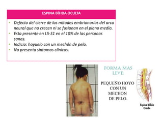 ESPINA BÍFIDA OCULTA
• Defecto del cierre de las mitades embrionarias del arco
neural que no crecen ni se fusionan en el plano medio.
• Esta presente en L5-S1 en el 10% de las personas
sanas.
• Indicio: hoyuelo con un mechón de pelo.
• No presenta síntomas clínicos.
 