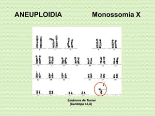 ANEUPLOIDIA Monossomia X
Síndrome de Turner
(Cariótipo 45,X)
 
