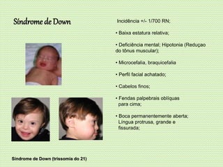 Incidência +/- 1/700 RN;
• Baixa estatura relativa;
• Deficiência mental; Hipotonia (Reduçao
do tônus muscular);
• Microcefalia, braquicefalia
• Perfil facial achatado;
• Cabelos finos;
• Fendas palpebrais oblíquas
para cima;
• Boca permanentemente aberta;
Língua protrusa, grande e
fissurada;
Síndrome de Down (trissomia do 21)
Síndrome de Down
 
