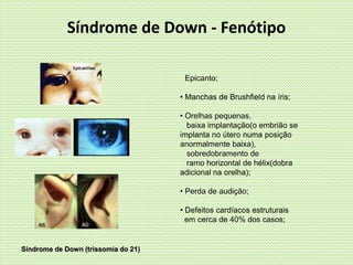 • Epicanto;
• Manchas de Brushfield na íris;
• Orelhas pequenas,
baixa implantação(o embrião se
implanta no útero numa posição
anormalmente baixa),
sobredobramento de
ramo horizontal de hélix(dobra
adicional na orelha);
• Perda de audição;
• Defeitos cardíacos estruturais
em cerca de 40% dos casos;
Síndrome de Down - Fenótipo
Síndrome de Down (trissomia do 21)
 