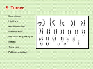 S. Turner
• Baixa estatura;
• Infertilidade;
• Anomalias cardíacas;
• Problemas renais;
• Dificuldades de aprendizagem;
• Diabetes;
• Oestoporose;
• Problemas na audição;
 