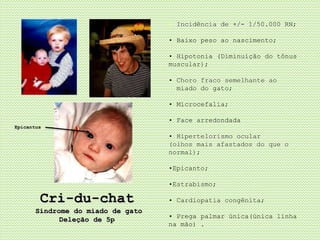 Cri-du-chat
Síndrome do miado de gato
Deleção de 5p
• Incidência de +/- 1/50.000 RN;
• Baixo peso ao nascimento;
• Hipotonia (Diminuição do tônus
muscular);
• Choro fraco semelhante ao
miado do gato;
• Microcefalia;
• Face arredondada
• Hipertelorismo ocular
(olhos mais afastados do que o
normal);
•Epicanto;
•Estrabismo;
• Cardiopatia congênita;
• Prega palmar única(única linha
na mão) .
Epicantus
 