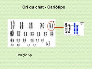 Cri du chat - Cariótipo
Deleção 5p
 
