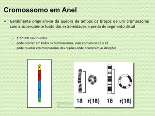 • Geralmente originam-se da quebra de ambos os braços de um cromossomo
com a subseqüente fusão das extremidades e perda de segmento distal
– 1:27.000 nascimentos
– pode ocorrer em todos os cromossomos, mais comum no 13 e 18
– pode resultar em monossomia das regiões onde ocorreram as deleções
Cromossomo em Anel
 