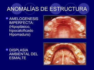 ANOMALÍAS DE ESTRUCTURA
AMELOGENESIS
IMPERFECTA:
(Hipoplásico,
hipocalcificado
Hipomaduro)
DISPLASIA
AMBIENTAL DEL
ESMALTE
 