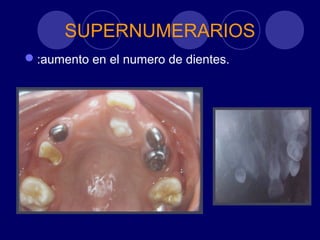 SUPERNUMERARIOS
:aumento en el numero de dientes.
 