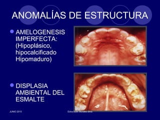 ANOMALÍAS DE ESTRUCTURA
AMELOGENESIS
IMPERFECTA:
(Hipoplásico,
hipocalcificado
Hipomaduro)
DISPLASIA
AMBIENTAL DEL
ESMALTE
JUNIO 2015 Edna Edith Morales Silva
 