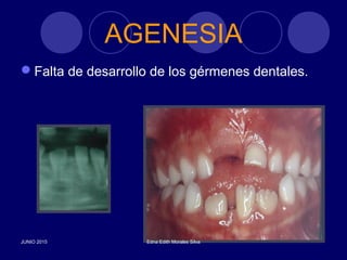AGENESIA
Falta de desarrollo de los gérmenes dentales.
JUNIO 2015 Edna Edith Morales Silva
 