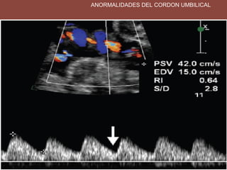 ANORMALIDADES DEL CORDON UMBILICAL
 
