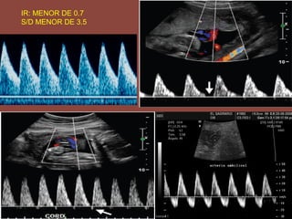 IR: MENOR DE 0.7
S/D MENOR DE 3.5
 