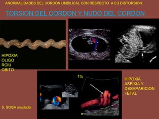 ANORMALIDADES DEL CORDON UMBILICAL CON RESPECTO A SU DISTORSION:
TORSION DEL CORDON Y NUDO DEL CORDON
1%
S. SOGA anudada
HIPOXIA
ASFIXIA Y
DESAPARICION
FETAL
HIPOXIA
OLIGO
RCIU
OBITO
 