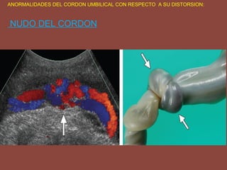 ANORMALIDADES DEL CORDON UMBILICAL CON RESPECTO A SU DISTORSION:
NUDO DEL CORDON
 
