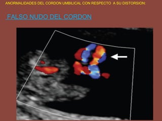 ANORMALIDADES DEL CORDON UMBILICAL CON RESPECTO A SU DISTORSION:
FALSO NUDO DEL CORDON
 