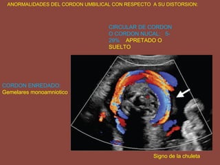 ANORMALIDADES DEL CORDON UMBILICAL CON RESPECTO A SU DISTORSION:
CIRCULAR DE CORDON
O CORDON NUCAL: 5-
29% APRETADO O
SUELTO
CORDON ENREDADO:
Gemelares monoamniotico
Signo de la chuleta
 