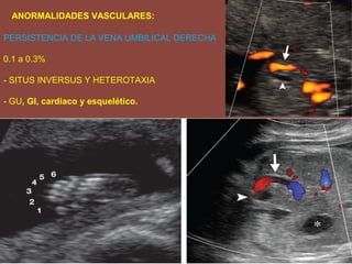 ANORMALIDADES VASCULARES:
PERSISTENCIA DE LA VENA UMBILICAL DERECHA
0.1 a 0.3%
- SITUS INVERSUS Y HETEROTAXIA
- GU, GI, cardiaco y esquelético.
 