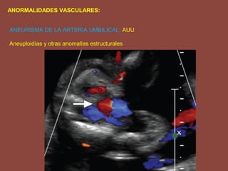 ANORMALIDADES VASCULARES:
ANEURISMA DE LA ARTERIA UMBILICAL: AUU
Aneuploidías y otras anomalías estructurales
 