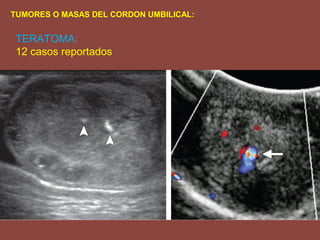 TUMORES O MASAS DEL CORDON UMBILICAL:
TERATOMA:
12 casos reportados
 