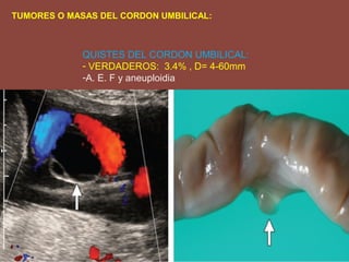 QUISTES DEL CORDON UMBILICAL:
- VERDADEROS: 3.4% , D= 4-60mm
-A. E. F y aneuploidia
TUMORES O MASAS DEL CORDON UMBILICAL:
 