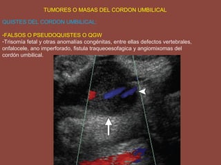 QUISTES DEL CORDON UMBILICAL:
-FALSOS O PSEUDOQUISTES O QGW
-Trisomía fetal y otras anomalías congénitas, entre ellas defectos vertebrales,
onfalocele, ano imperforado, fistula traqueoesofagica y angiomixomas del
cordón umbilical.
TUMORES O MASAS DEL CORDON UMBILICAL
 