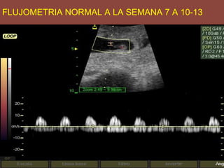 FLUJOMETRIA NORMAL A LA SEMANA 7 A 10-13
 