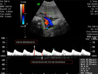 ANORMALIDADES DEL CORDON UMBILICAL
(NUDO)
PICO SISTOLICO
VELOCIDAD DE FIN DE DIASTOLE
 