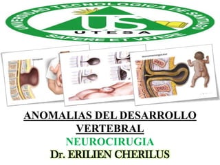 ANOMALIAS DEL DESARROLLO
VERTEBRAL
NEUROCIRUGIA
Dr. ERILIEN CHERILUS

 