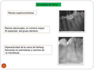 Anomalías de forma
Raíces supernumerarias
Hiperactividad de la vaina de Hertwig
frecuente en premolares y caninos de
la mandíbula.
Raíces adicionales, en número mayor
Al esperado, del grupo dentario.
13
 