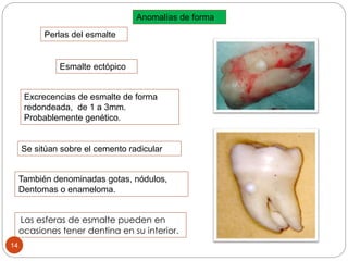 Anomalías de forma
Perlas del esmalte
Las esferas de esmalte pueden en
ocasiones tener dentina en su interior.
Esmalte ectópico
También denominadas gotas, nódulos,
Dentomas o enameloma.
Excrecencias de esmalte de forma
redondeada, de 1 a 3mm.
Probablemente genético.
Se sitúan sobre el cemento radicular
14
 
