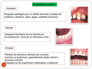 Anomalías de forma
Abrasión
Atrición
Erosión
Desgaste patológico por un hábito anormal o empleo de
sustancia abrasiva (pipa, aguja, cepillado excesivo).
Desgaste fisiológico de los dientes por
la masticación, varía de un individuo a otro.
Pérdida de estructura dentaria por proceso
químico no bacteriano, generalmente ácidos (limón),
anorexia (vómito)
Desgaste en las superficies vestibulares o palatinas.
15
 