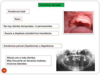 Anomalías dentales
Anodoncia total
No hay dientes temporales, ni permanentes.
Asocia a displasia ectodérmica hereditaria.
Anodoncia parcial (hipodoncia) u oligodoncia
Afecta uno o más dientes.
Más frecuente en terceros molares,
incisivos laterales.
16
Raro.
 