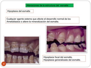 Alteraciones de la estructura del esmalte
Hipoplasia focal del esmalte.
Hipoplasia generalizada del esmalte.
Hipoplasia del esmalte
Cualquier agente externo que afecte el desarrollo normal de los
Ameloblastos o altere la mineralización del esmalte.
20
 