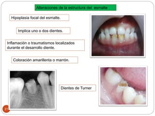 Hipoplasia focal del esmalte.
Implica uno o dos dientes.
Dientes de Turner
Inflamación o traumatismos localizados
durante el desarrollo diente.
Alteraciones de la estructura del esmalte
21
Coloración amarillenta o marrón.
 