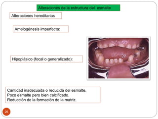 26
Cantidad inadecuada o reducida del esmalte.
Poco esmalte pero bien calcificado.
Reducción de la formación de la matriz.
Hipoplásico (focal o generalizado):
Alteraciones de la estructura del esmalte
Alteraciones hereditarias
Amelogénesis imperfecta:
 