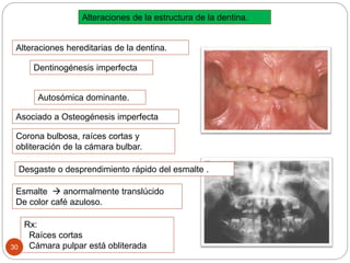 Alteraciones de la estructura de la dentina.
Alteraciones hereditarias de la dentina.
Dentinogénesis imperfecta
Autosómica dominante.
Esmalte  anormalmente translúcido
De color café azuloso.
Corona bulbosa, raíces cortas y
obliteración de la cámara bulbar.
Rx:
Raíces cortas
Cámara pulpar está obliterada30
Desgaste o desprendimiento rápido del esmalte .
Asociado a Osteogénesis imperfecta
 