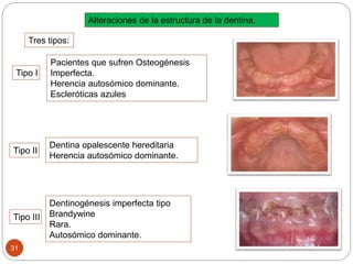 Alteraciones de la estructura de la dentina.
Tres tipos:
Tipo I
Pacientes que sufren Osteogénesis
Imperfecta.
Herencia autosómico dominante.
Escleróticas azules
Tipo II
Dentina opalescente hereditaria
Herencia autosómico dominante.
Tipo III
Dentinogénesis imperfecta tipo
Brandywine
Rara.
Autosómico dominante.
31
 
