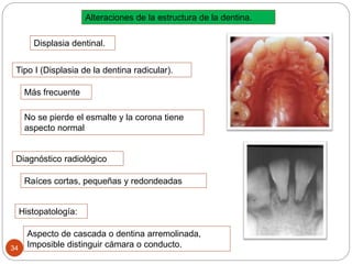 Alteraciones de la estructura de la dentina.
Displasia dentinal.
Tipo I (Displasia de la dentina radicular).
Más frecuente
No se pierde el esmalte y la corona tiene
aspecto normal
Diagnóstico radiológico
Raíces cortas, pequeñas y redondeadas
Histopatología:
Aspecto de cascada o dentina arremolinada,
Imposible distinguir cámara o conducto.34
 