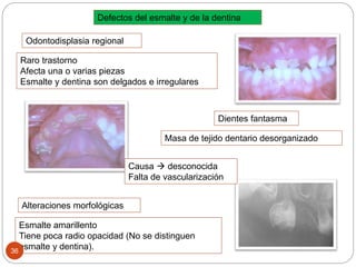 Defectos del esmalte y de la dentina
Odontodisplasia regional
Raro trastorno
Afecta una o varias piezas
Esmalte y dentina son delgados e irregulares
Masa de tejido dentario desorganizado
Dientes fantasma
Causa  desconocida
Falta de vascularización
Alteraciones morfológicas
Esmalte amarillento
Tiene poca radio opacidad (No se distinguen
esmalte y dentina).36
 