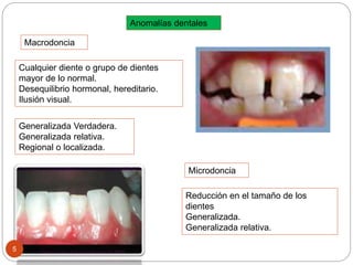 Microdoncia
Macrodoncia
Cualquier diente o grupo de dientes
mayor de lo normal.
Desequilibrio hormonal, hereditario.
Ilusión visual.
Anomalías dentales
Reducción en el tamaño de los
dientes
Generalizada.
Generalizada relativa.
5
Generalizada Verdadera.
Generalizada relativa.
Regional o localizada.
 