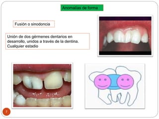 Anomalías de forma
Fusión o sinodoncia
Unión de dos gérmenes dentarios en
desarrollo, unidos a través de la dentina.
Cualquier estadio
7
 