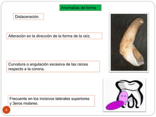 Anomalías de forma
Dislaceración.
Alteración en la dirección de la forma de la raíz.
Frecuente en los incisivos laterales superiores
y 3eros molares.
9
Curvatura o angulación excesiva de las raíces
respecto a la corona.
 