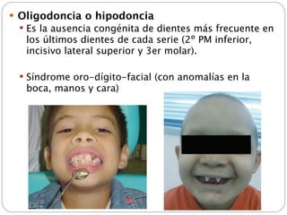  Oligodoncia o hipodoncia
  Es la ausencia congénita de dientes más frecuente en
   los últimos dientes de cada serie (2º PM inferior,
   incisivo lateral superior y 3er molar).

  Síndrome oro-dígito-facial (con anomalías en la
   boca, manos y cara)
 