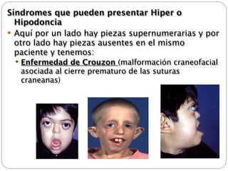 Síndromes que pueden presentar Hiper o
  Hipodoncia
 Aquí por un lado hay piezas supernumerarias y por
  otro lado hay piezas ausentes en el mismo
  paciente y tenemos:
  Enfermedad de Crouzon (malformación craneofacial
   asociada al cierre prematuro de las suturas
   craneanas)
 