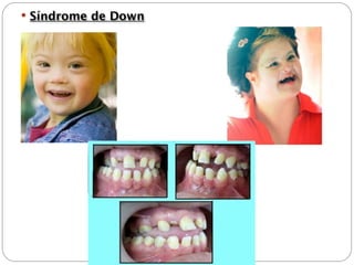  Síndrome de Down
 